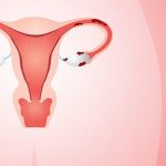 9 حقائق يجب أن تعرفها كل امرأة  عن بطانة الرحم Endometriosis