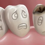 علاج تسوس الأسنان وطرق علاجه